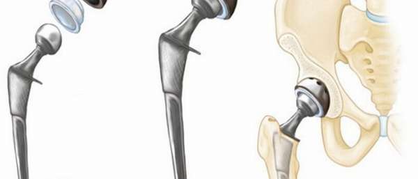 Тотальное эндопротезирование тазобедренного сустава: ход операции